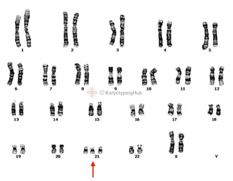 karyotype of Down syndrome