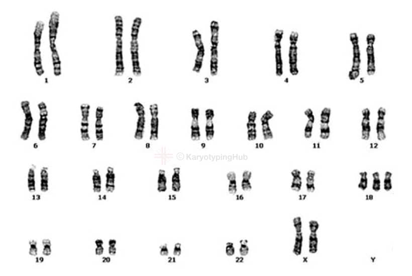 A karyotype of Edwards syndrome 