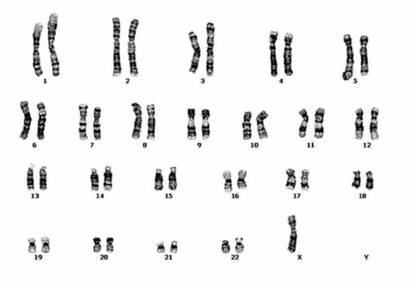 A Karyotype Of Turner Syndrome Explained Karyotypinghub