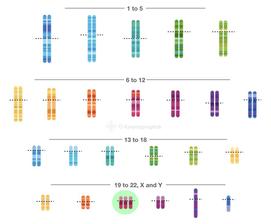 The karyotype of Down syndrome